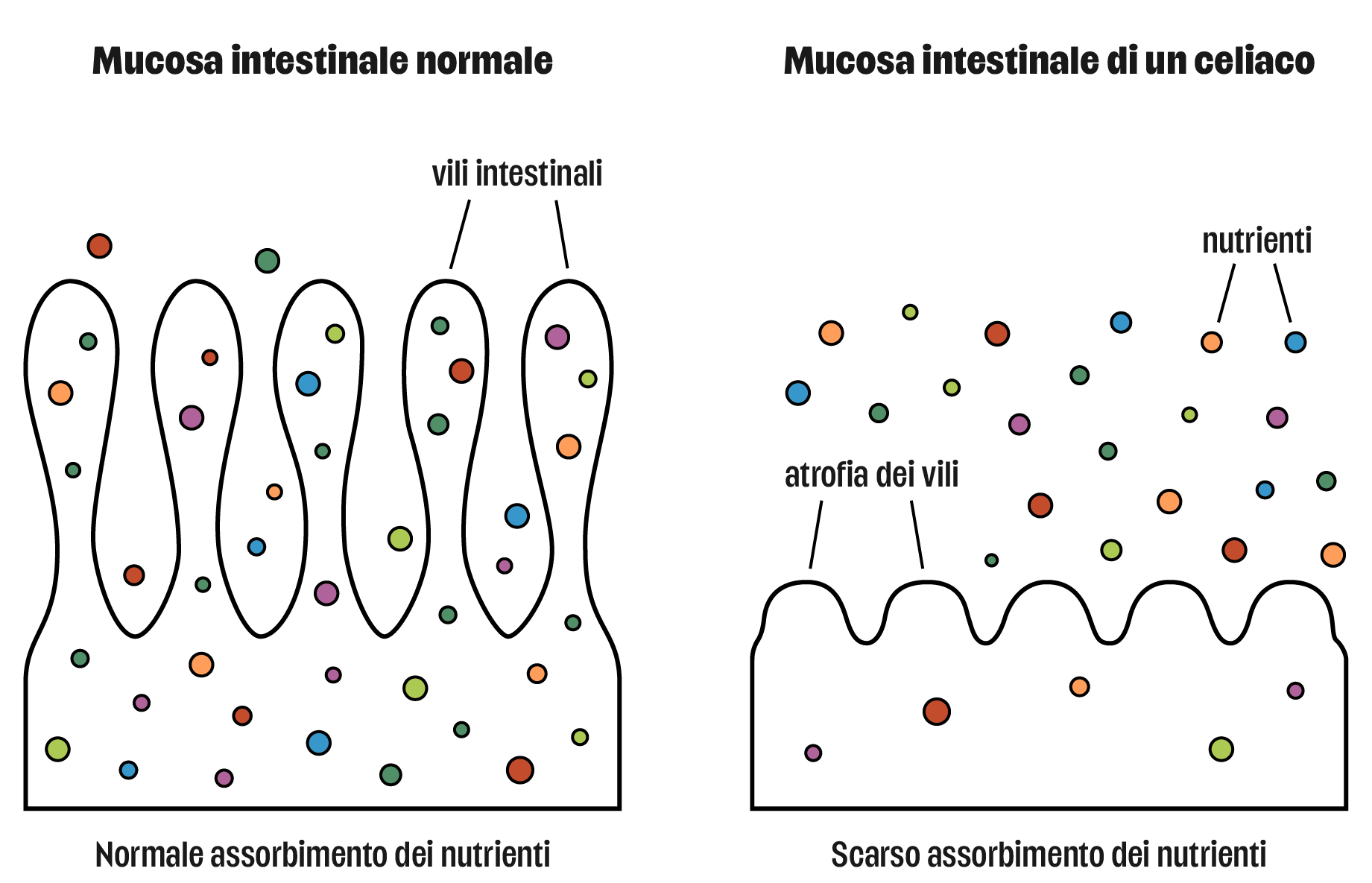 Infografica: confronto tra mucosa intestinale normale e mucosa intestinale di un celiaco